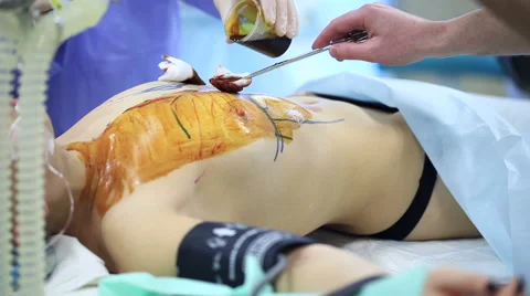 The girl on the operating table Stock-Footage 61114161