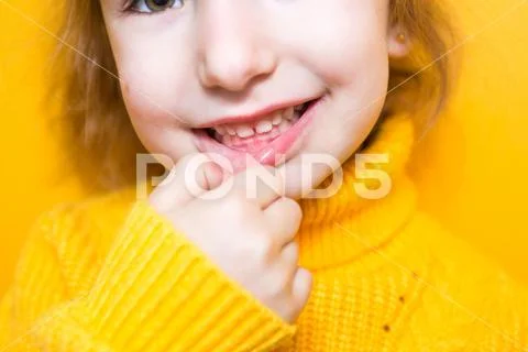 Girl shows her teeth-pathological bite, malocclusion, overbite ...