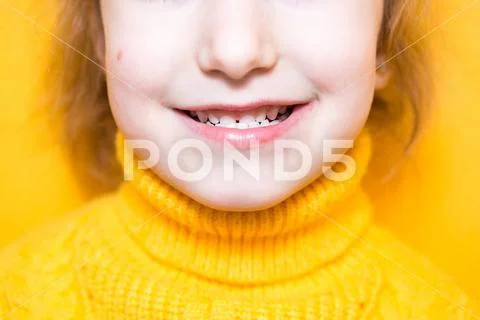 Girl shows her teeth-pathological bite, malocclusion, overbite ...