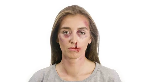 Girl on a white background with bruises Stock Footage 120487548