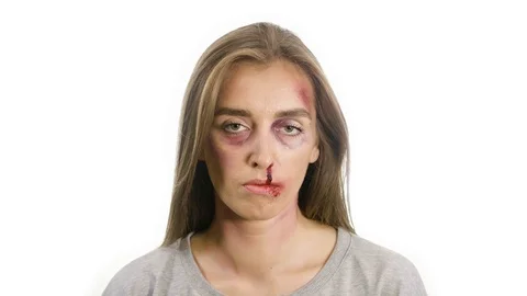 Girl on a white background with bruises Stock Footage 120487635