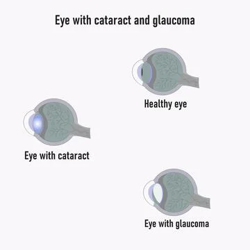 Glaucoma eye. Development of Glaucoma. Stock Illustration
