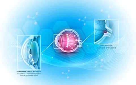 Glaucoma the eye disease Stock Illustration