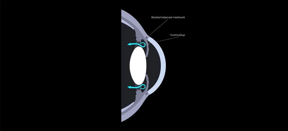Glaucoma eye disease Stock Illustration