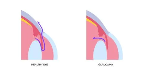 Glaucoma eye disease Stock Illustration