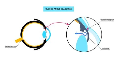 Glaucoma eye disease Stock Illustration