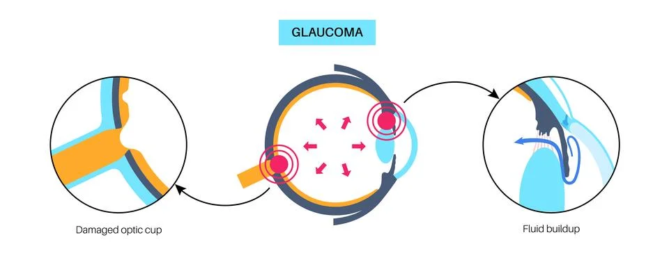 Glaucoma eye disease Stock Illustration