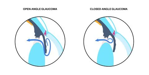 Glaucoma eye disease Stock Illustration