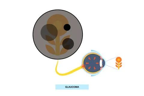 Glaucoma eye disease Stock Illustration