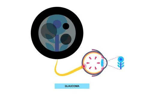 Glaucoma eye disease Stock Illustration