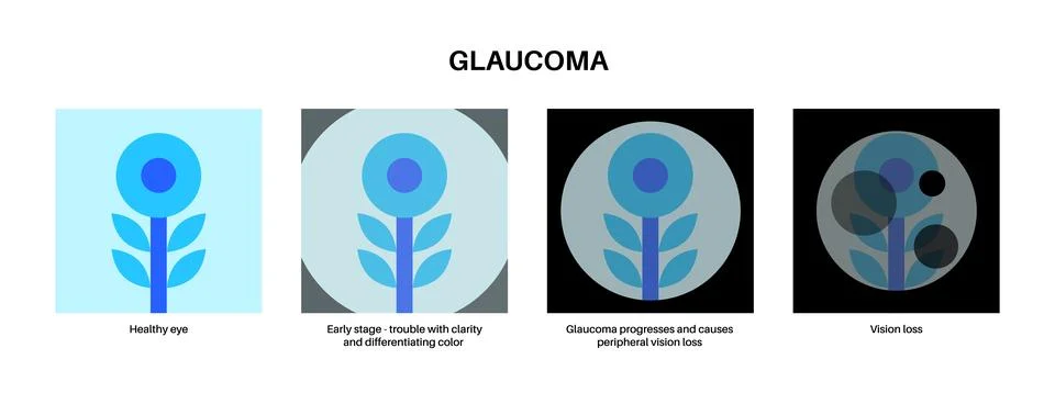 Glaucoma eye disease Stock Illustration