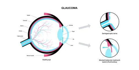 Glaucoma eye disease Illustrazione stock