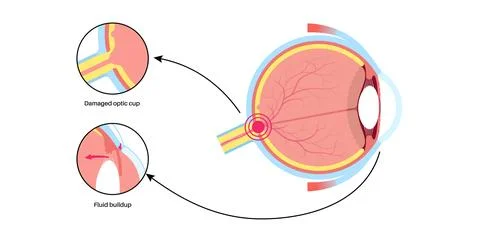 Glaucoma eye disease Illustrazione stock