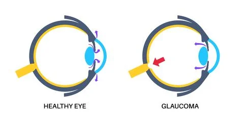 Glaucoma eye pressure Stock Illustration