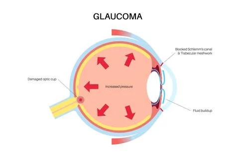 Glaucoma eye pressure Stock Illustration