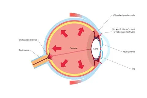 Glaucoma eye pressure Stock Illustration
