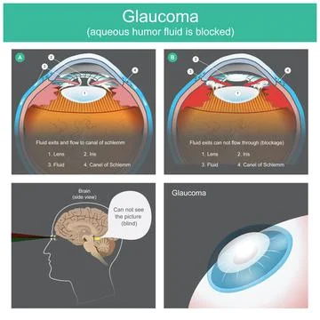 Glaucoma. Human eye lens. Stock Illustration