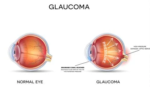 Glaucoma Ilustração Stock
