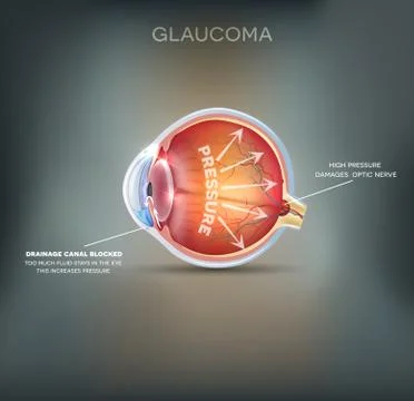 Glaucoma Stock Illustration