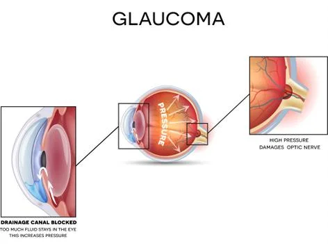 Glaucoma Stock Illustration