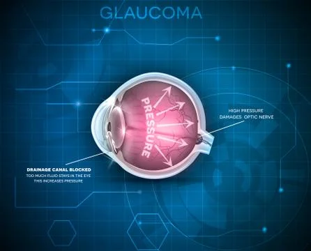 Glaucoma Stock Illustration
