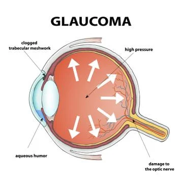 Glaucoma. Stock illustration. 스톡 일러스트