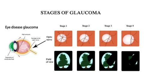Glaucoma. The structure of the eye. The field of vision in glaucoma. Atrophy of Stock Illustration