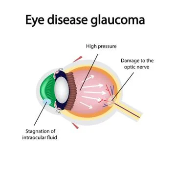 Glaucomatous eye. Violations causing glaucoma Stock Illustration