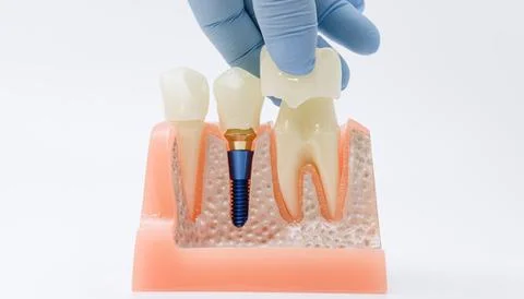 Gloved hand aligning crown over dental implant model Stock Photos