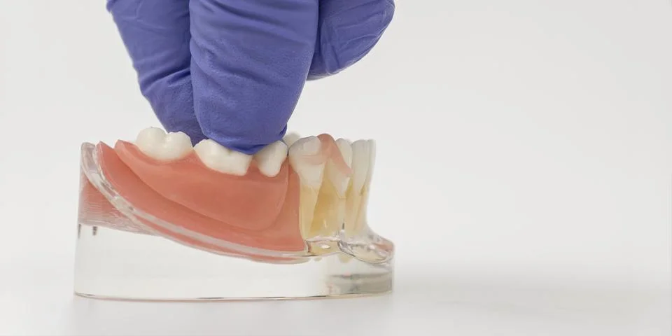 Gloved Hand Placing Removable Partial Denture on Jaw Model Stock Photos