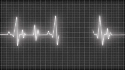 Glowing ecg heartbeat waveform on grid background animation, Electrocardiog.. Stock Footage 335116777