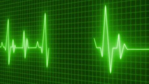 Glowing ecg heartbeat waveform on grid background animation, Electrocardiog.. Stock Footage 335116926