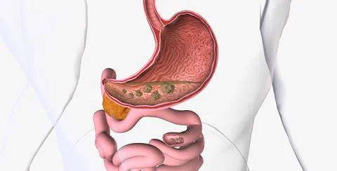 Glucose is the body primary source of fuel and is either converted into energ Stock Illustration