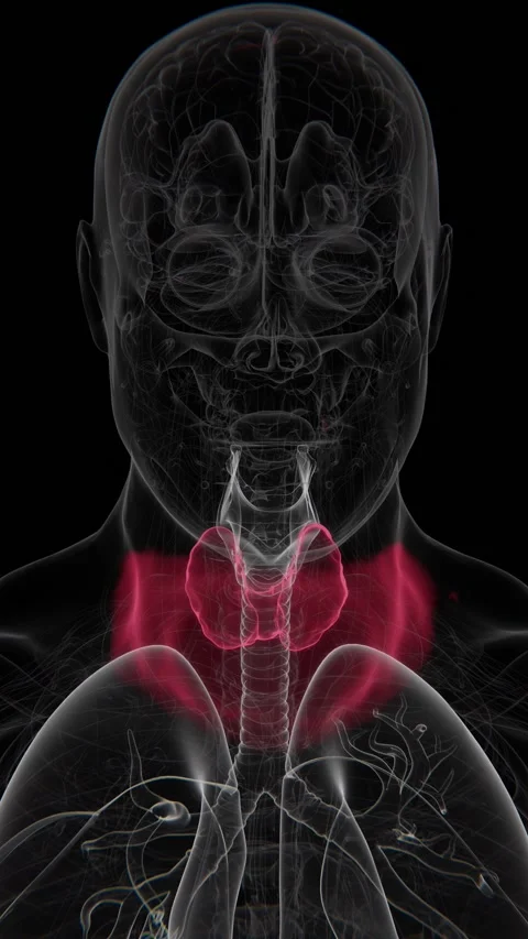 Goiter is an enlargement of the thyroid gland that can occur due to thyroid Stock Footage 342828617