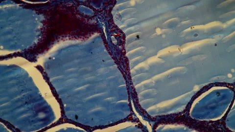 Goiter thyroid tissue with colloid Stock Footage 343951476