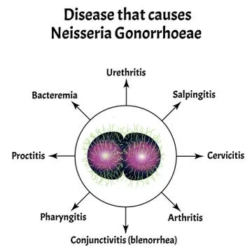 Gonococcus structure. Disease that causes Neisseria gonorrhoeae. Gonorrhea Stock Illustration