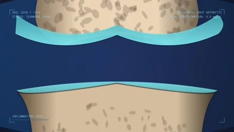 Gout Arthritis Simulation With Uric Acid Crystals Accumulating In Joint Stock Footage 340604235
