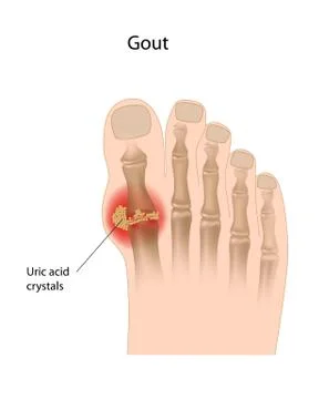 Gout of the big toe Stock Illustration