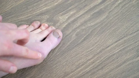 Gout on the leg close-up.	 Stock Footage 148939825