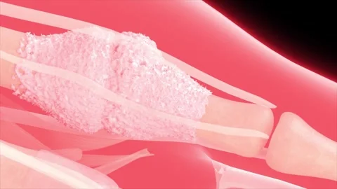 Gout: urate crystals grow in toe joints, causing painful Stockbeeldmateriaal 345199008