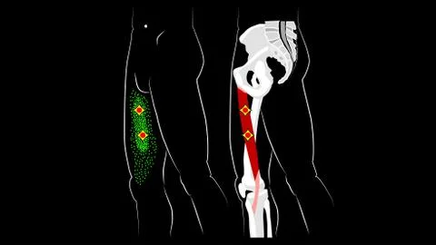 Gracilis muscle. Structure, trigger points, and reflected pain in the thigh Illustrazione stock
