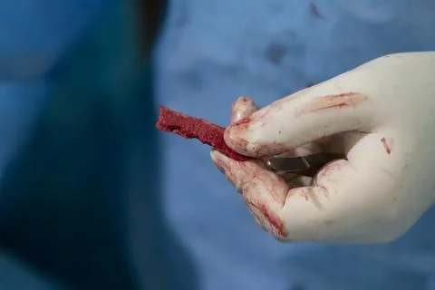 Grafted Bone Close-up Stockfoto's