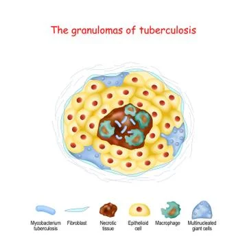 The granulomas of tuberculosis. structure of granuloma Illustration