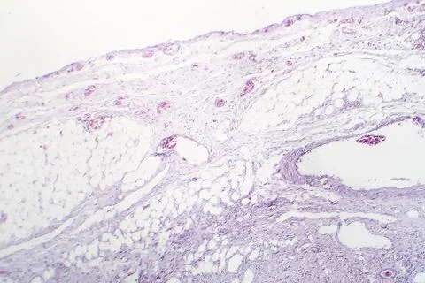 Granulomatous inflammation, light micrograph Stock Photos
