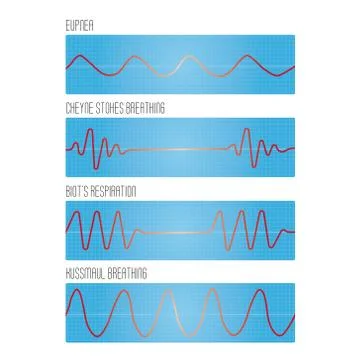 Graph of breathing, the pathological types of breathing: normal breathing, .. Illustrazione stock