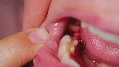 Graphic macro a bleeding socket in the gum after tooth removal Stock Footage 346472197
