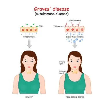 Graves' disease. Illustrazione stock