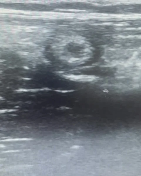Grayscale Appendix Sonogram During an Acute Appendicitis Examination Video stock 288891646