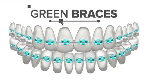 Green Child Braces Vector. Tooth And Dental Braces. Human Jaw. 3D Realistic イラスト素材