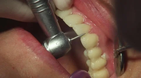 Grinding dental veneers Stock Footage 61156181